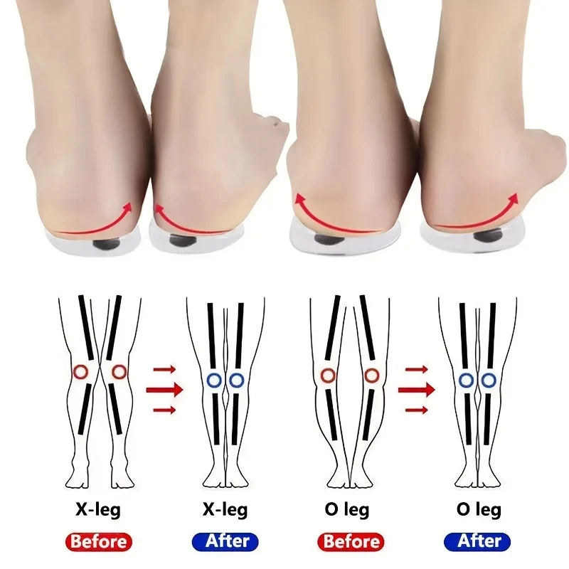 Women Shoes Types - 발 O/X 다리 유형 Valgus 교정을위한